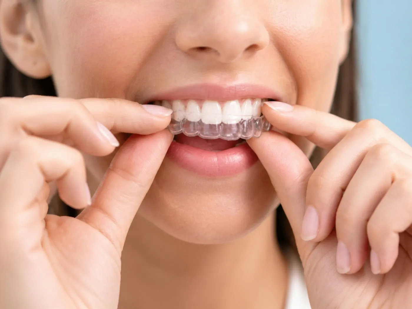 Close-up of a smiling person pressing a clear aligner tray onto their upper teeth