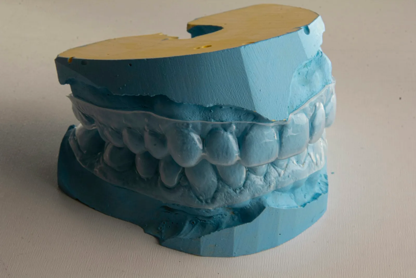 Thin clear plastic tray fitted over a blue dental model on beige